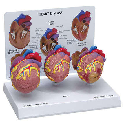 Heart Disease Model Set