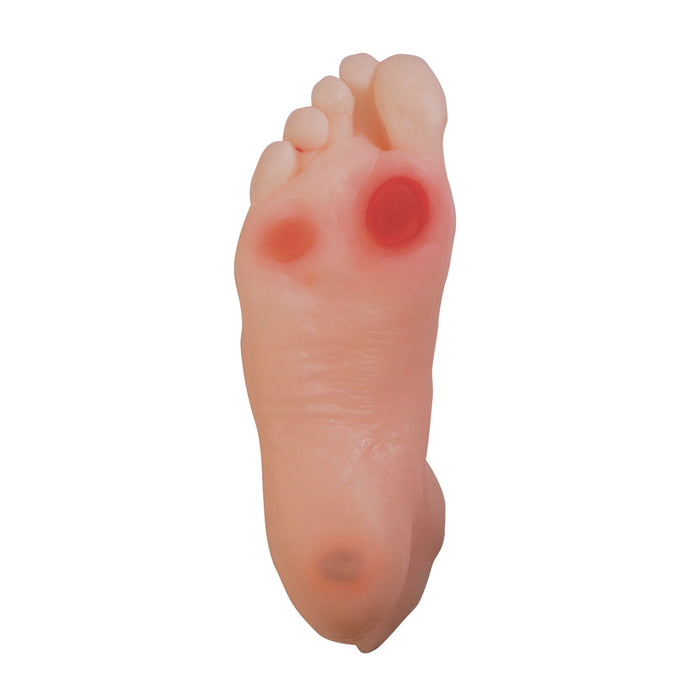 diabetic foot model, appearance of 3 ulcers, cracked skin, diabetic neuropathy, realistic look and feel, Health Edco, 26101