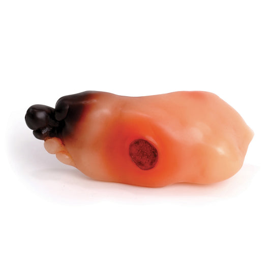 severe diabetic foot model, important foot care, blood glucose, amputated toe, severe infection, gangrene, foot ulcer, Health Edco, 26150