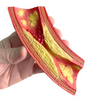 Deadly Obstruction Artery Model, health education anatomical artery model showing atherosclerosis, Health Edco, 26989