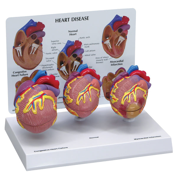 Heart Disease Model Set