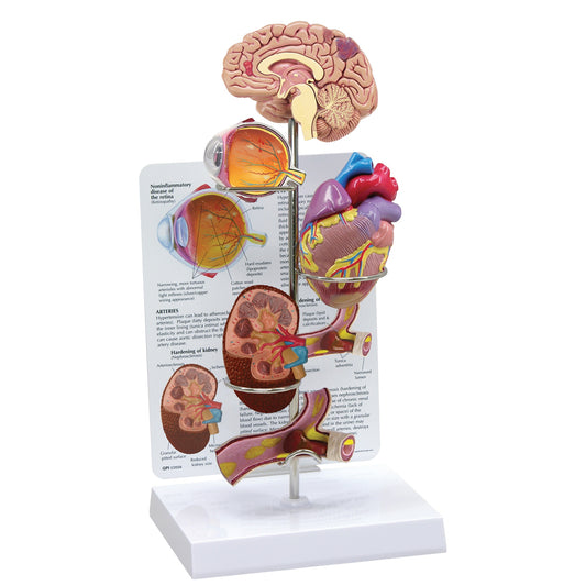 Hypertension Mini-Model Set