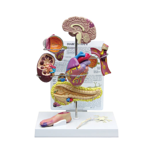 Type II Diabetes Model Set