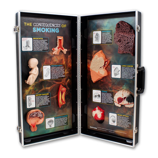 Smoking Consequences 3-D Display, health education display with models in case showing smoking harms, Health Edco, 78881