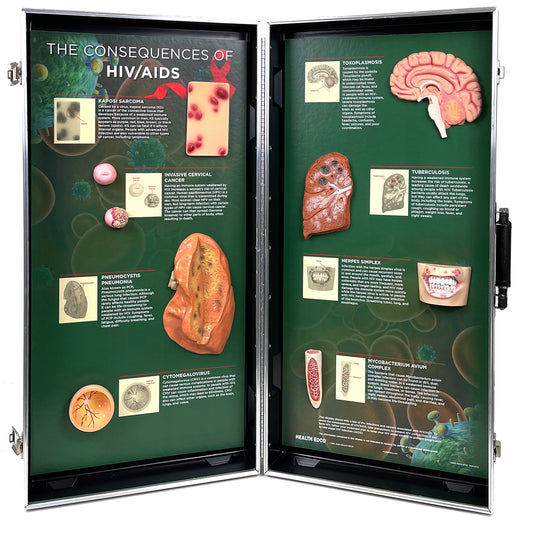HIV/AIDS Consequences 3-D Display for health education by Health Edco with models of AIDS opportunistic infections, 78882