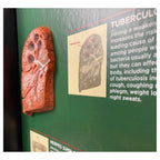 HIV/AIDS Consequences 3-D Display for health education by Health Edco, close-up of tuberculosis and herpes models, 78882