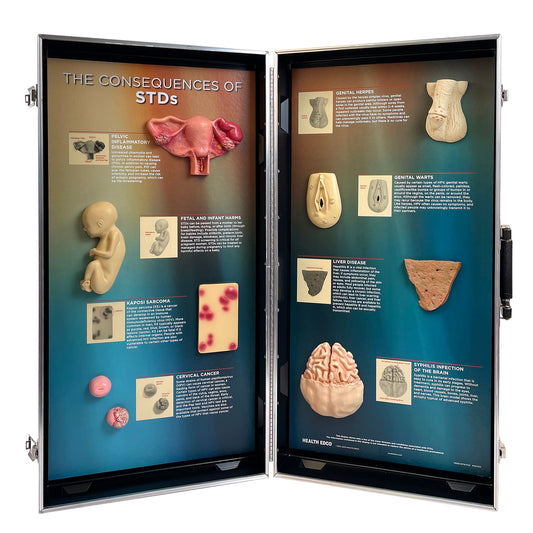 STDs Consequences 3-D Display, health education display showing effects of sexually transmitted diseases, Health Edco, 78926