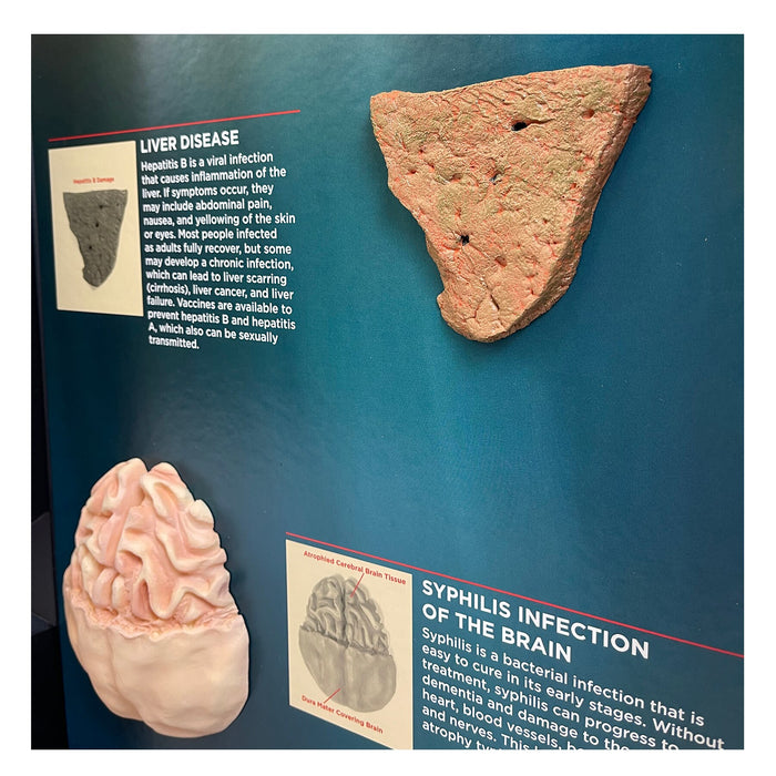 STDs Consequences 3-D Display, models of liver disease and syphilis of the brain in health teaching tool, Health Edco, 78926
