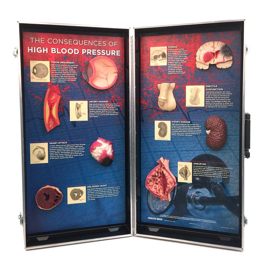 High Blood Pressure Consequences 3D Display from Health Edco for heart health education with hypertensive organ models, 78927