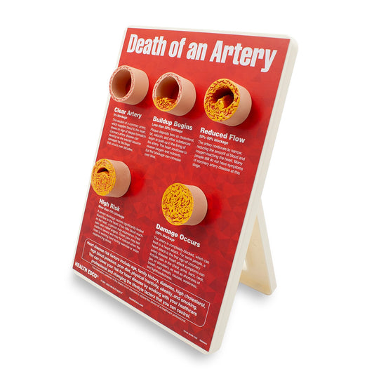 Death of an Artery Easel Display for heart health education by Health Edco with artery models depicting plaque buildup, 79149