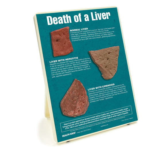 Death of a Liver Easel Display, health education display with liver models showing liver damage, Health Edco, 79150