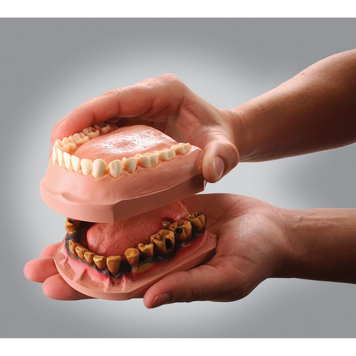 Dip N Decay Model Set, interactive tobacco education tool, healthy teeth model and tobacco teeth model, Health Edco, 79166