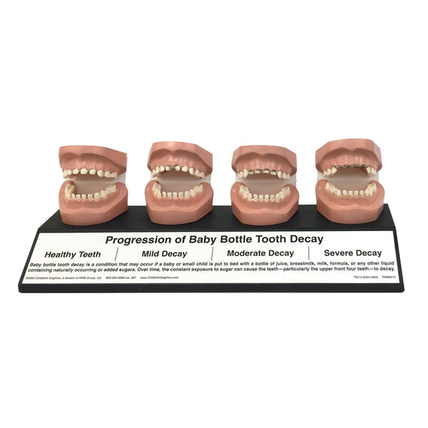 Progression Of Baby Bottle Tooth Decay Display