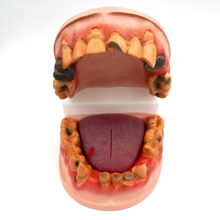 Meth Mouth: An Inside Look Display for health education by Health Edco, mouth model showing oral damage of meth abuse, 79758