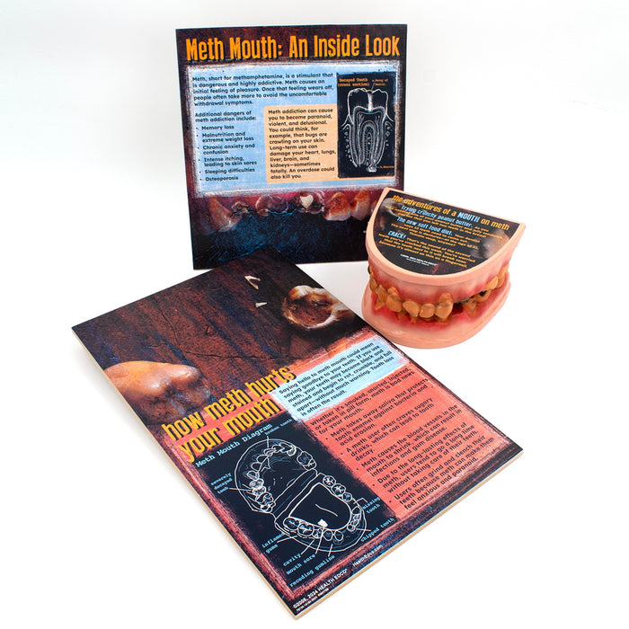 Meth Mouth: An Inside Look Display for health education by Health Edco, mouth model showing oral damage of meth abuse, 79758